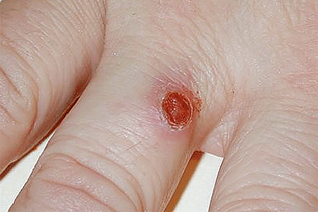Merkel cell carcinoma on this patient's hand looked like a growing sore that healed and returned