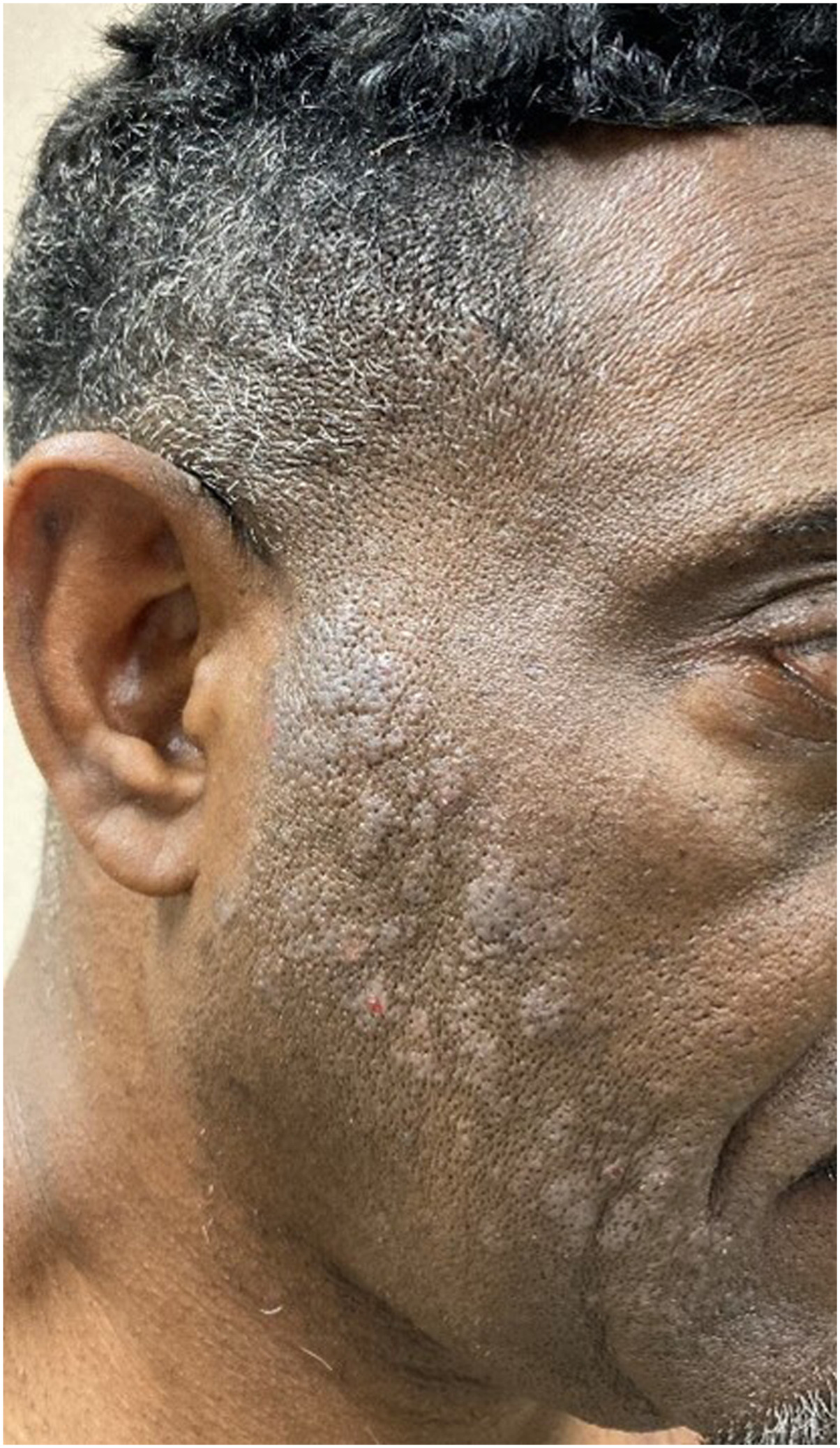The image demonstrates an allergic contact dermatitis that developed within 48 hours after applying black hair dye containing paraphenylenediamine | American Academy of Dermatology (AAD).