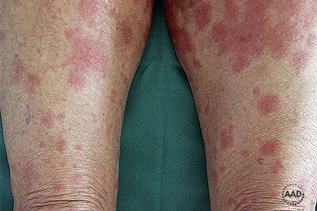 Bullous pemphigoid blisters - Stock Image - C055/9327 - Science