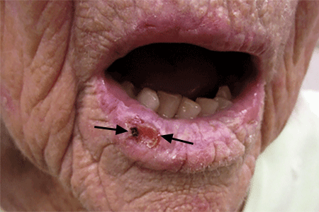A recurring sore on this patient's lip is squamous cell carcinoma skin cancer