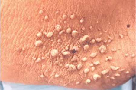 Several skin tags on a person’s skin