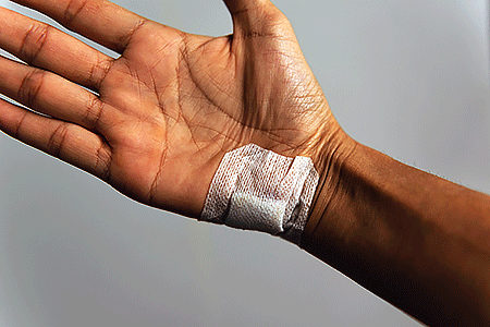 Bandage covers skin biopsy wound on man’s palm