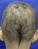 Image for DWII on short anagen syndrome