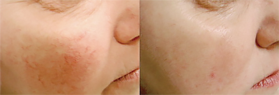 Rosacea patient before and after with laser treatment