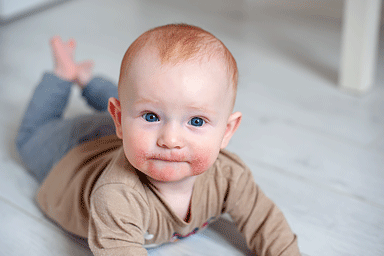 Atopic dermatitis on the face of a baby