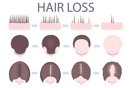 Illustration of male and female pattern hair loss.
