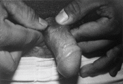 Image for sclerosing lymphangitis of the penis 