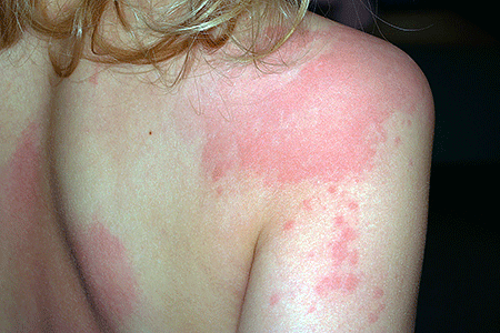 Girl with hives on shoulder, arm, and back.