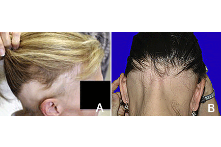 Alopecia ophiasis causing a band of hair loss from the back of the head to the temples (A) and woman with alopecia ophiasis (B).