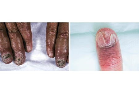 Nail changes due to sarcoidosis and fingernail destroyed by sarcoidosis