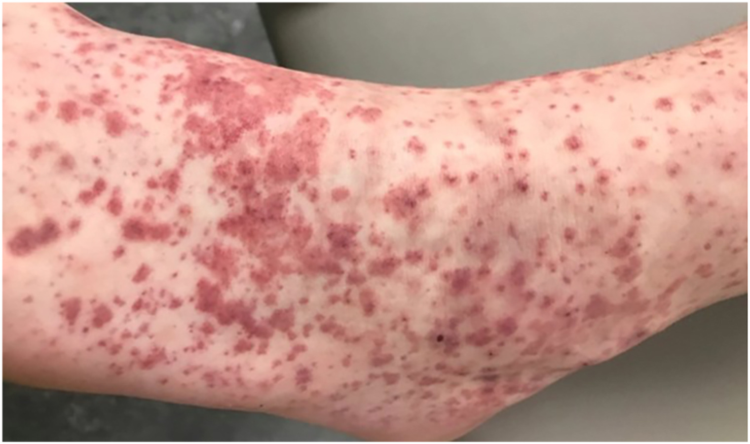 Figure 1. Palpable purpura on the ankle and dorsal foot in an adult patient with IgA vasculitis, which may be associated with HBV. Source: JAAD. (3)