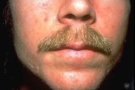 Close-up of a man with seborrheic dermatitis on face