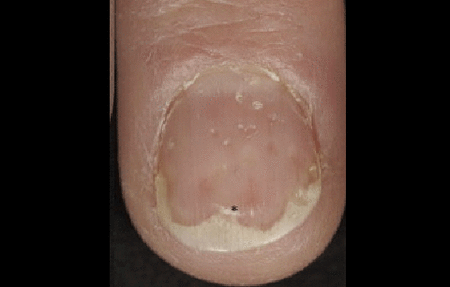 nail psoriasis causing tiny dents and white discolored nail