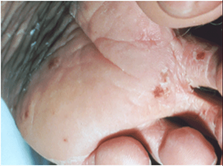 Ringworm infection between the toes