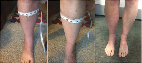 Image from Bilateral lower extremity inflammatory lymphedema” by Robinson et al 
