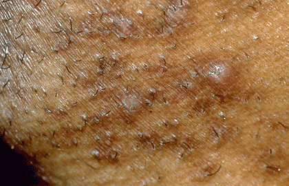 folliculitis genital area