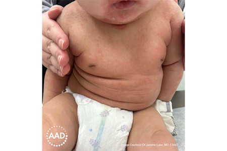 Pink or red baby eczema rash