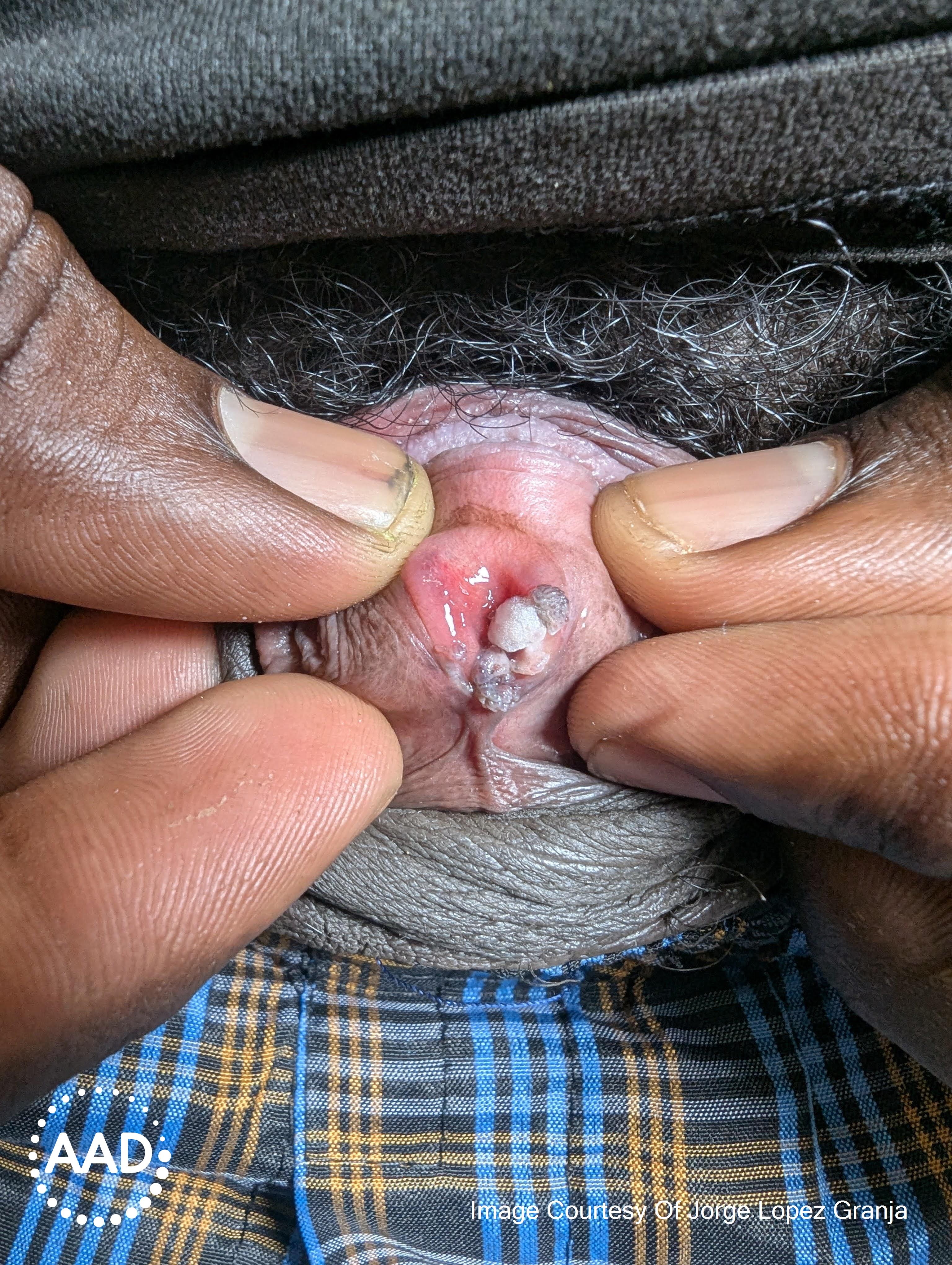 Figure 3. Multiple exophytic verrucous, papules arising from urethral meatus. Source: AAD.