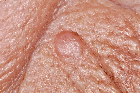 Round, raised basal cell carcinoma is the same color as the patient’s skin 