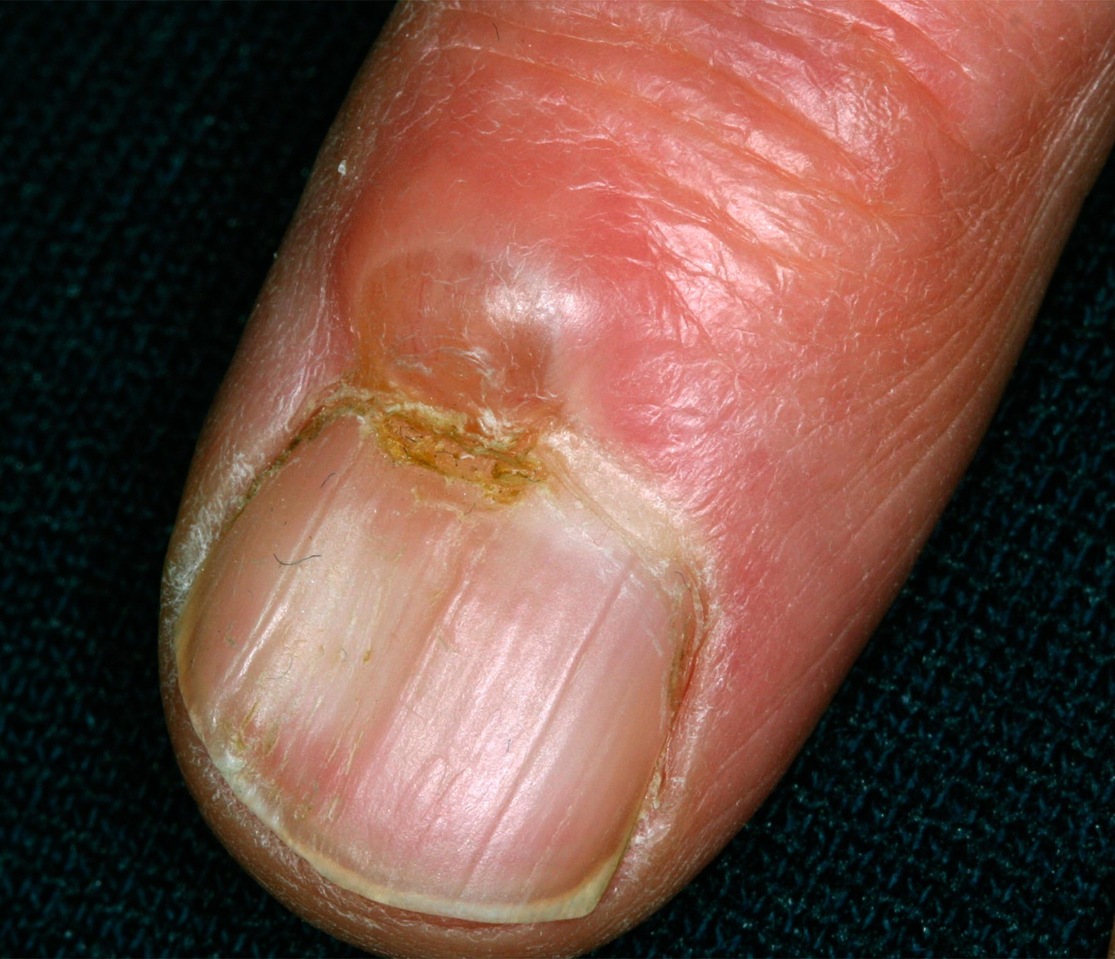 Image for DWII of a finger with a digital mucous cyst near the fingernail | American Academy of Dermatology (AAD). 