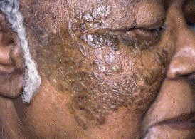 Image for DWII on Demodex eruptions, showing a woman's face with a demodectic eruption