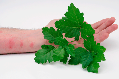 Poison oak leaves held by someone with a poison oak rash on their arm