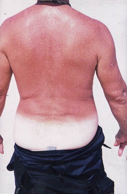 Image for DWII of skin reddened by a sunburn