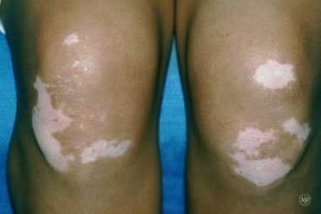 Vitiligo: Overview