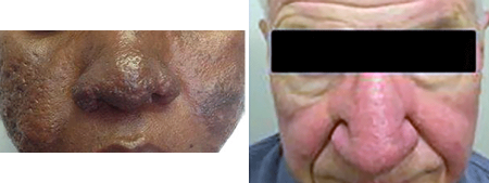 Thickening skin on nose and cheeks due to rosacea (left), red face with thickening skin on nose due to rosacea (right)
