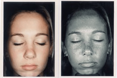 Hidden UV sun damage on teenager's face