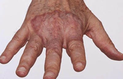 Granuloma annulare often causes a slightly raised patch on your skin