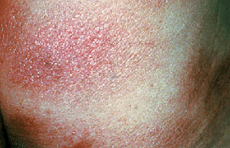 Early on, the rash due to mycosis fungoides often looks like a sunburn