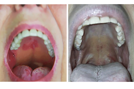 Patch on roof of patient’s mouth due to pityriasis rosea (left). Pityriasis rosea inside patient’s mouth (right).