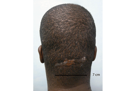 Scar on back of head due to acne keloidalis nuchae