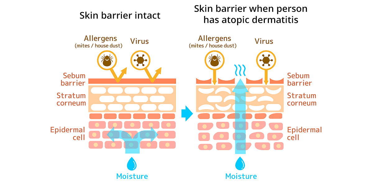 atopic dermatitis causes