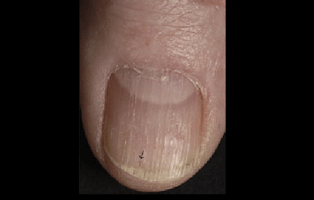 nail ridging psoriasis)