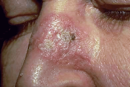 Discoid lupus often looks like a raised, thick, scaly patch