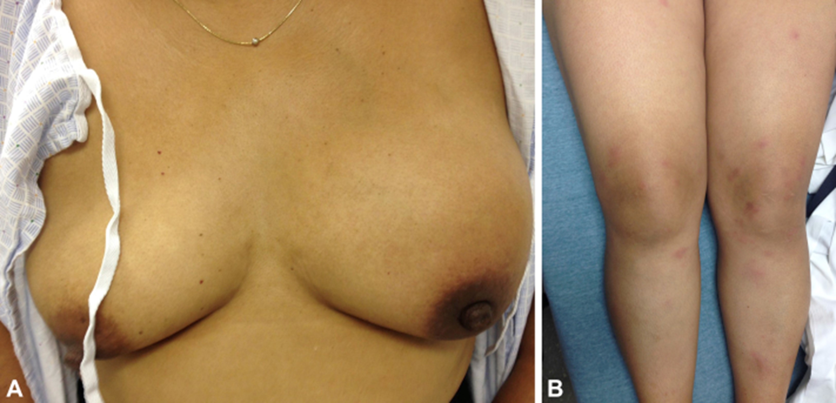 Image of a swollen, indurated left breast and clinically diagnosed erythema nodosum of the lower extremities, from reference 13.