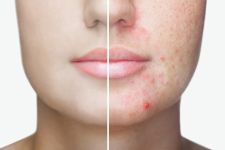 woman's face before/after image of acne and clear skin