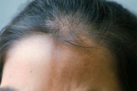 Scleroderma en coup de sabre on forehead