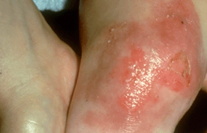 Epidermolysis bullosa blisters on baby’s knee