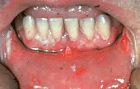 Pemphigus vulgaris develop mouth sores
