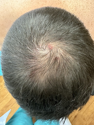 Image of acne necrotica for DermWorld Insights and Inquiries 