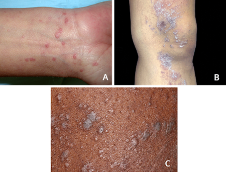 Lichen planus caused a rash of shiny, red bumps on this person’s wrist (A), Purple bumps on leg caused by lichen planus (B), Gray bumps on skin caused by lichen planus (C)