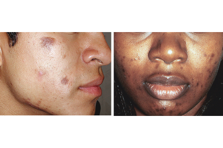 Large spots of post-inflammatory hyperpigmentation and hyperpigmentation on cheeks and chin
