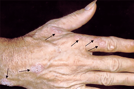 The white, scaly, wart-like growths on this patient's hand are actinic keratosis precancerous skin growths.