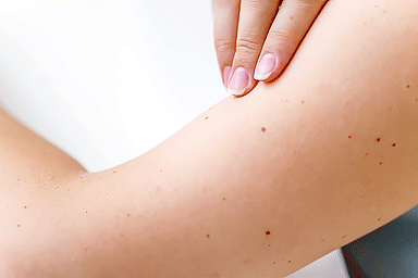 Birthmarks or a mole on a woman's skin