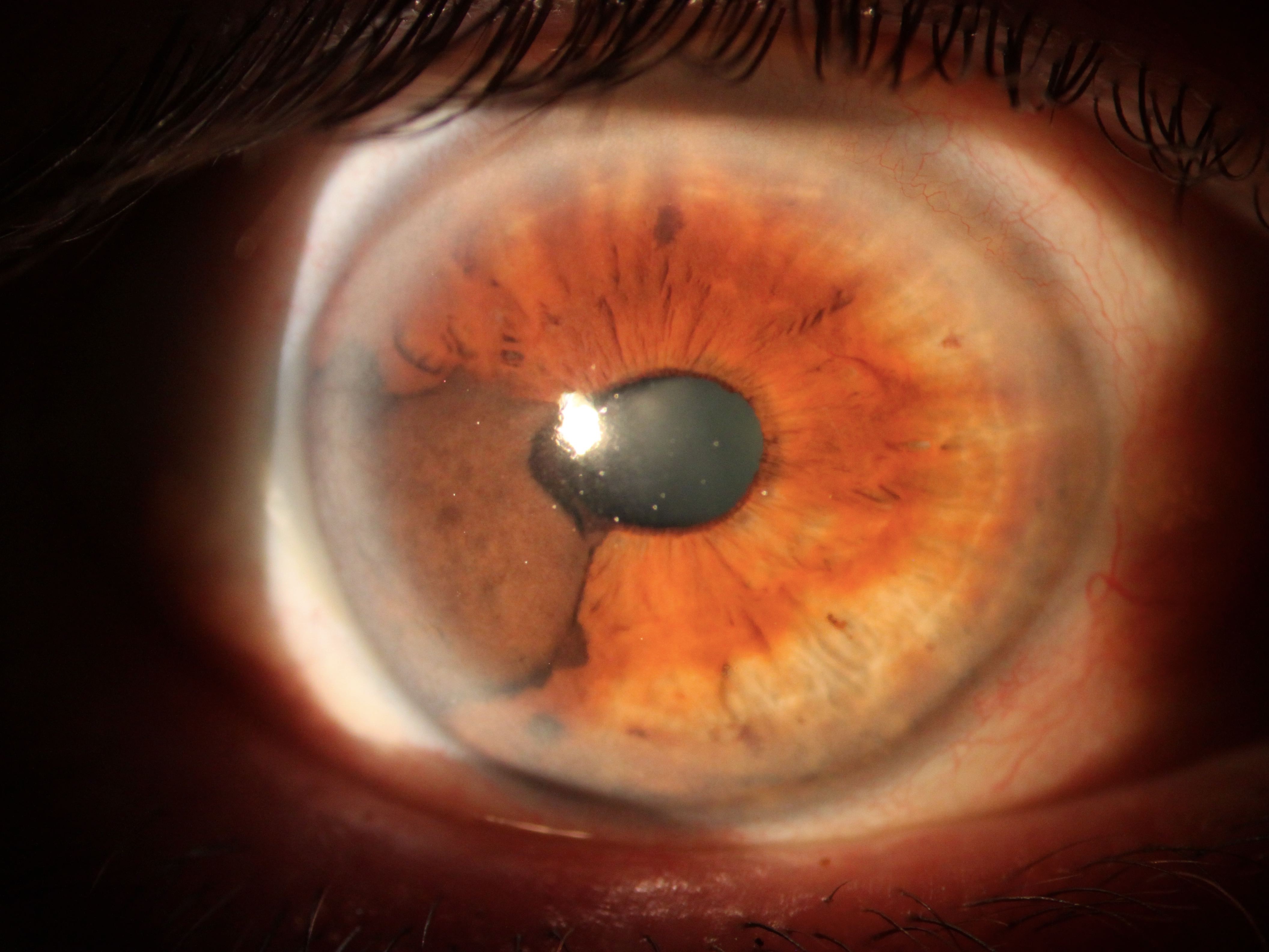 Image for DWII on uveal melanoma