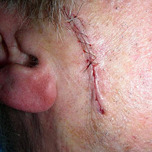 Image for DWII of a sutured wound 