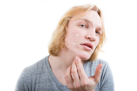người đàn ông trẻ điều trị mụn trên mặt